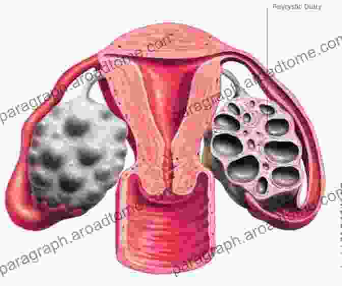 A Woman With Polycystic Ovary Syndrome Psychological Aspects Of Polycystic Ovary Syndrome