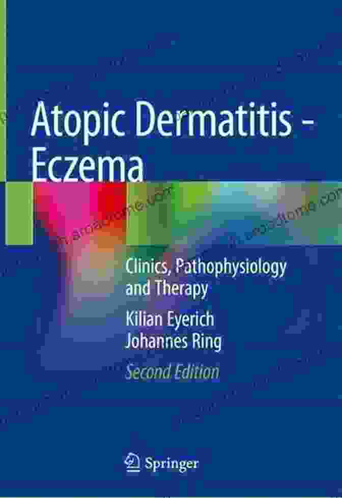 Atopic Dermatitis: Eczema By Johannes Ring Atopic Dermatitis: Eczema Johannes Ring