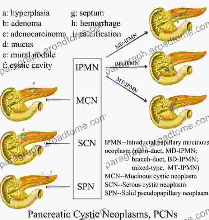 Case Study Examples Pancreatic Cystic Neoplasms: From Imaging To Differential Diagnosis And Management