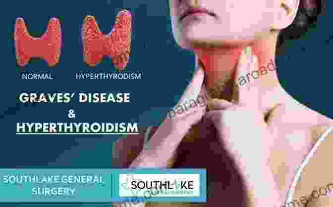 Grave's Disease In Autoimmune Thyroiditis Autoimmune Thyroiditis: Approaches Towards Its Etiological Differentiation