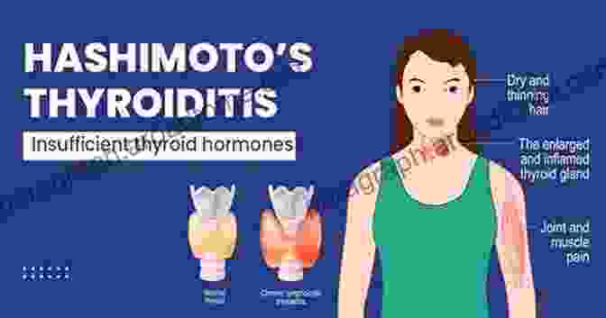 Hashimoto's Thyroiditis In Autoimmune Thyroiditis Autoimmune Thyroiditis: Approaches Towards Its Etiological Differentiation