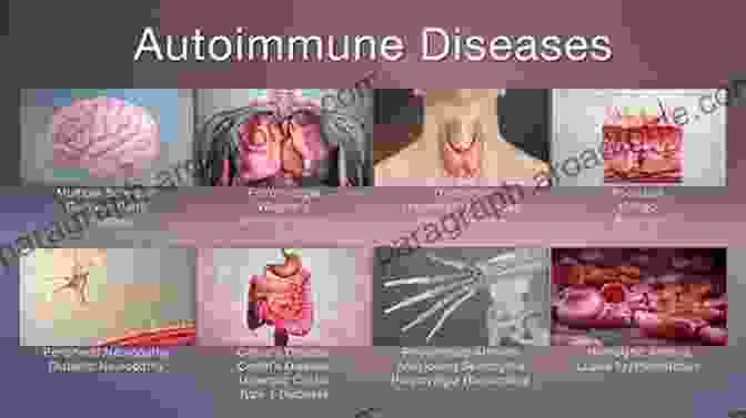 Immune Dysregulation In Autoimmune Thyroiditis Etiology Autoimmune Thyroiditis: Approaches Towards Its Etiological Differentiation