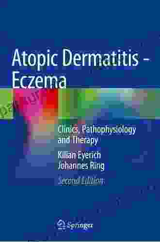 Atopic Dermatitis: Eczema Johannes Ring